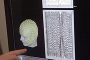 Neue Behandlungsmethoden bei Epilepsie