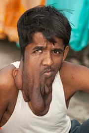 Lalit Ram from India has neurofibromatosis and was known as Elephant Man.