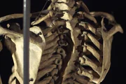 Skoliose - neue Therapieansätze für einen gesunden Rücken