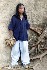 Picture Shows: Dede Koswara, known as Tree Man, has growths caused by the HPV virus ---