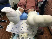 Infected feet