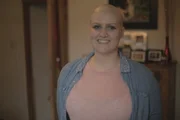 Samantha Rose - Alopecia Areata.