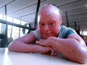 Nelly Shaheen from Coventry, UK, has harlequin ichthyosis.