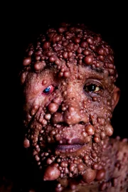 Picture Shows: Lauw Tjoan Eng from Jakarta, Indonesia, has bubbles all over his skin