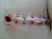 Bauchoperation
