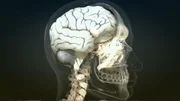 Die Alzheimer-Krankheit ist durch ein langsam fortschreitendes Absterben von Nervenzellen und deren Verbindungen untereinander gekennzeichnet.