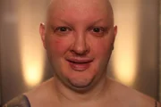 Chris Boyle - Ectodermal Dysplasia.