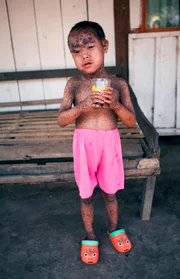 Picture Shows: Rohim Revelation from Indonesia has the skin condition Lamellar Ichthyosis