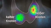 Schilddrüse Grafik: Kalter Knoten / heißer Knoten.