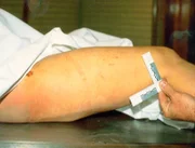 Die Ermittler stellen fest, dass die Schrammen am rechten Bein des Mädchens von einer Gurtbefestigung herrühren. Wurde sie in einem Auto ermordet?