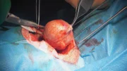 Doctors in the dermatology clinic are operating on the largest and most curious tumor.
