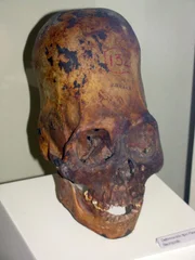Alien Knochenstruktur im Schädel
