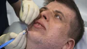 Der Arzt betäubt die darüber liegende Haut und macht dann einen möglichst kleinen Schnitt, um die Kapsel mit den abgestorbenen Hautzellen vollständig zu entfernen.