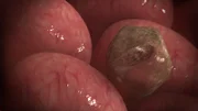 Coccidioides immitis