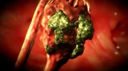 Teratoma.