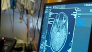 Wissenschaftler:innen weltweit haben Hoffnungen, dass der Wirkstoff der Pilze helfen kann gegen psychische Krankheiten, wie Depressionen, Angststörungen. Die Forschungen sind noch am Anfang – noch ist unklar, wie genau Psilocybin im Gehirn wirkt
