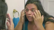 Hilda, who suffers from ulcers around the eyes.