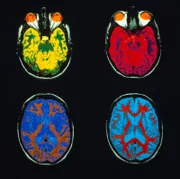 MRI scans of normal brain (Colour Enhanced)