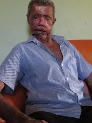 Sun intolerant villager with damaged face.