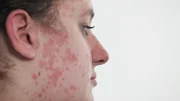 Spots on the face.