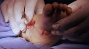 Peruvian boy has corrective surgery on his sideways feet.