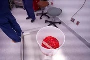 Amy Dench's large tumor sits in a bucket on a tray. It has been removed, and looks bloody and even still has a strip of skin on top of the mass.
