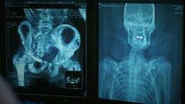 CT-Scan von Duncan MacPhersons Leichnam.