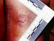 Florida 1993: Zum Gl&uuml;ck hat sich ein Opfer gegen den Touristen-M&ouml;rder zur Wehr gesetzt und &uuml;berlebt. Eine Bisswunde erweist sich als hei&szlig;e Spur.