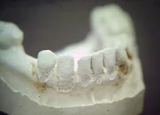 Das Gebiss des Str&auml;flings Lemuel Smith ist identisch mit der Biss-Spur auf dem K&ouml;rper der Gef&auml;ngnisw&auml;rterin Donna Payant.