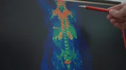 Ein PET-Scan macht die braunen Fettzellen im K&ouml;rper sichtbar - hier in rot. PET-Scan