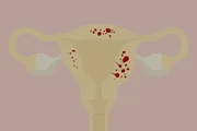 Bei der sogenannten „Adenomyose“ wachsen Endometriose-Herde in die Muskelschicht der Gebärmutter ein. Bei der sogenannten „Adenomyose“ wachsen Endometriose-Herde in die Muskelschicht der Gebärmutter ein.