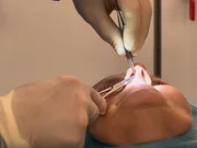 Sportlehrerin Astrid Hobi erhofft sich von der Knorpel-Transplantation von ihrer Nase ins Knie Schmerzfreiheit und neue Lebensqualit&auml;t.