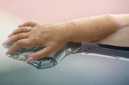 Da Prothesen nur bedingt Selbstst&auml;ndigkeit erm&ouml;glichen, w&auml;chst das Interesse an Handtransplantationen. Doch die Operation ist in Europa ein medizinisches Novum und mit hohen Risiken verbunden.