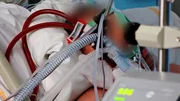 Beatmeter Covid-19-Patient an Lungenmaschine.