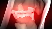 Bei Arthrose kommt es zu einem schmerzhaften Abbau des Gelenkknorpels.