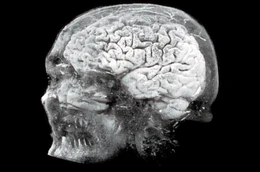 Dank moderner Methoden lassen sich aus den Daten eines MRTs heute auch 3D-Modelle des Gehirns errechnen. Mit bis zu 100 Milliarden Nervenzellen ist das Gehirn das komplexeste Organ, das der Mensch besitzt.
