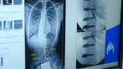 Skoliose im Röntgenbild: Familie Haasjes will eine Versteifung von Rosas gekrümmter Wirbelsäule verhindern. Das wäre die aktuelle Standardtherapie. Sie setzen stattdessen auf eine neuartige OP-Methode, bei der die Wirbelsäule begradigt wird, aber die Beweglichkeit erhalten bleiben soll. Skoliose im Röntgenbild: Familie Haasjes will eine Versteifung von Rosas gekrümmter Wirbelsäule verhindern. Das wäre die aktuelle Standardtherapie. Sie setzen stattdessen auf eine neuartige OP-Methode, bei der die Wirbelsäule begradigt wird, aber die Beweglichkeit erhalten bleiben soll.