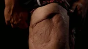 Kawika-Verletzung. Kawika-Verletzung.