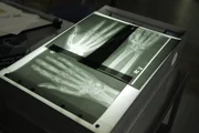 Picture Shows: X-ray images of hand skeletons on lightbox.
