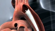 Bei einem Aortenaneurysma überbrückt der Gefäßchirurg den erweiterten Bereich mit einem sogenannten Stentgraft.